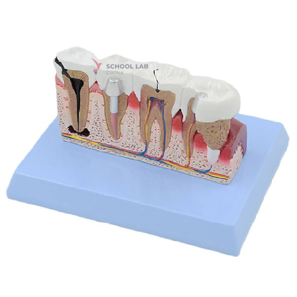 Teeth Common Pathologies Model
